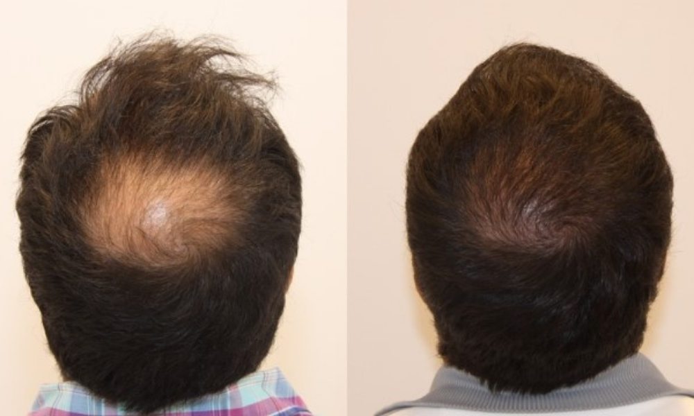 SMP For Hair Density
