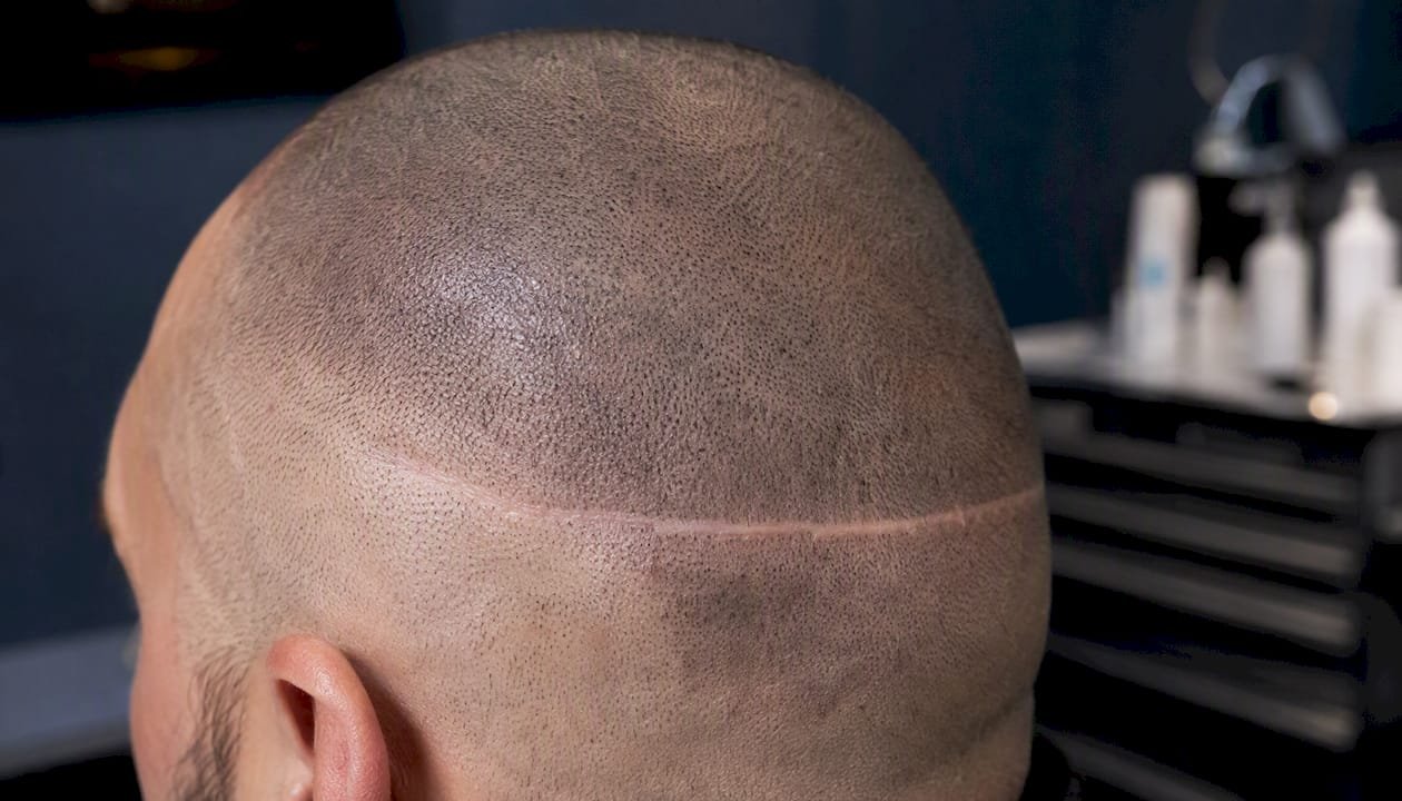 Close-up of scalp scar camouflaged by SMP dots