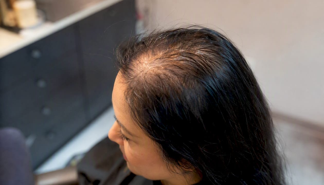 Scalp close-up showing diffuse thinning hair