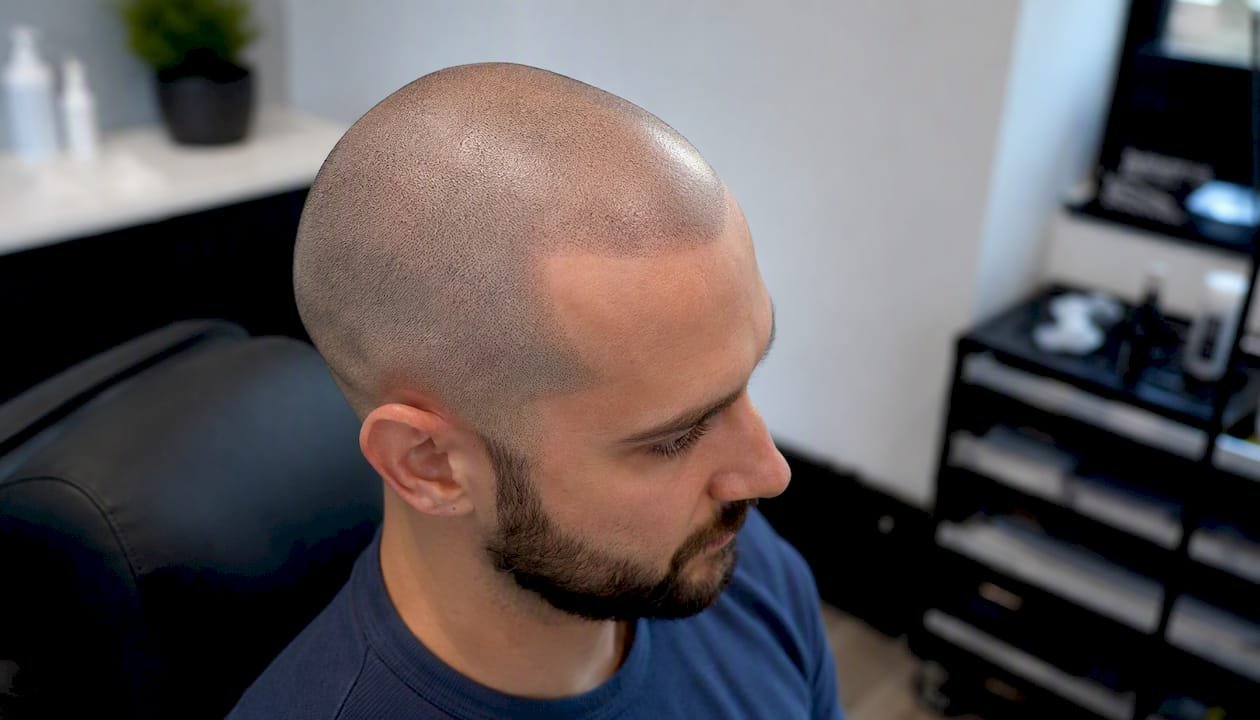 Healed scalp micropigmentation showing natural density and texture