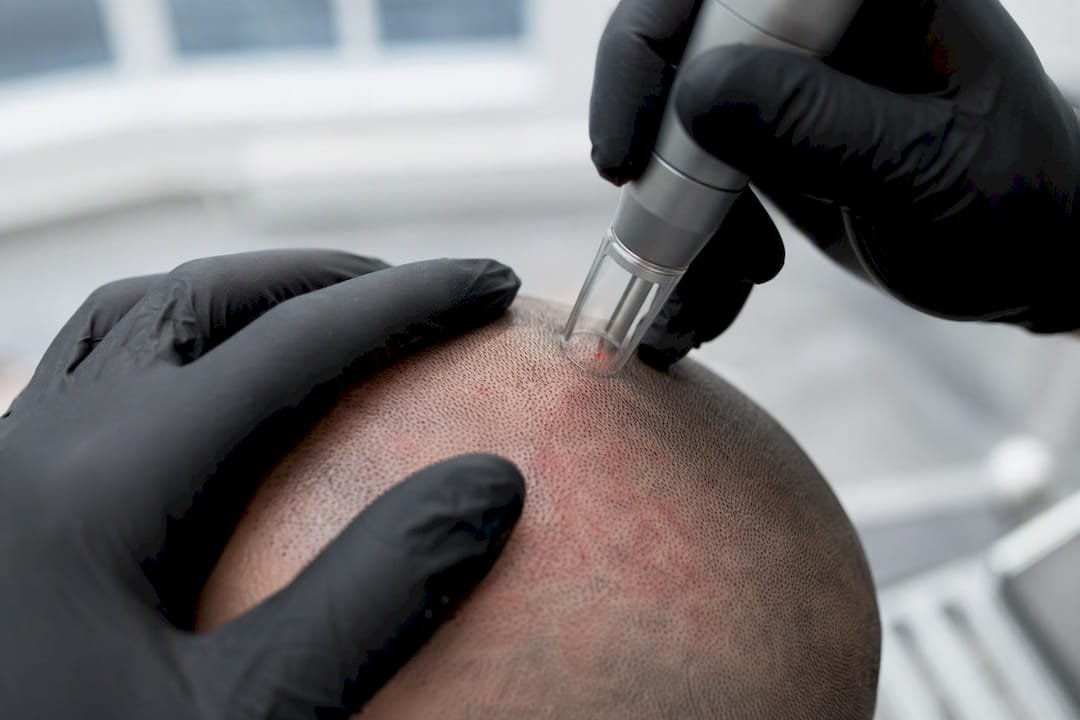 Laser device performing SMP removal on scalp area