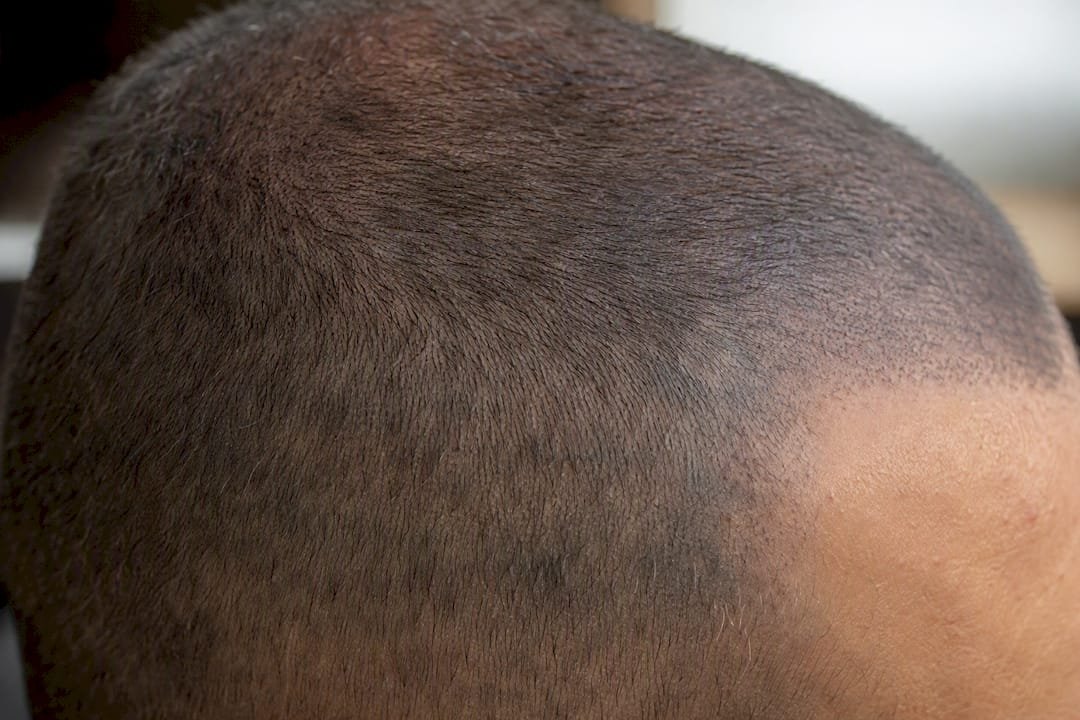 Uneven fading visible on pigmented scalp close-up