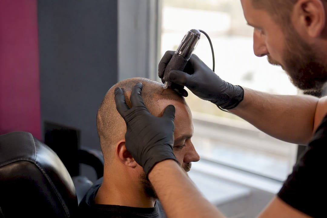 Technician performing SMP on receding hairline