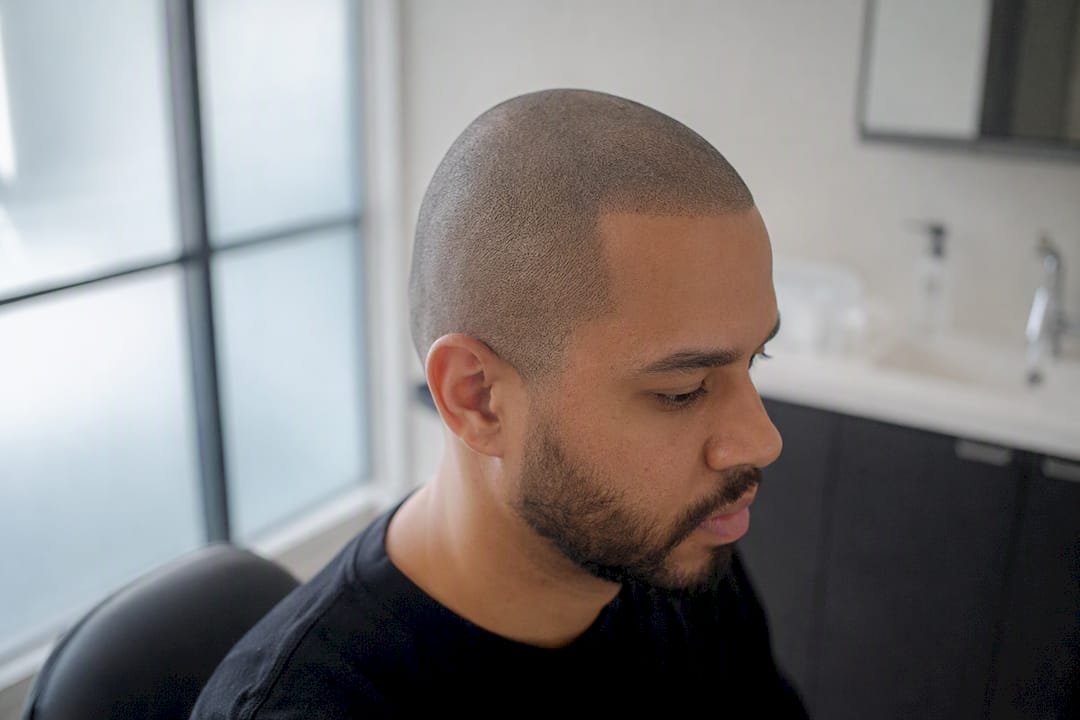 Healed SMP scalp showing natural hairline restoration