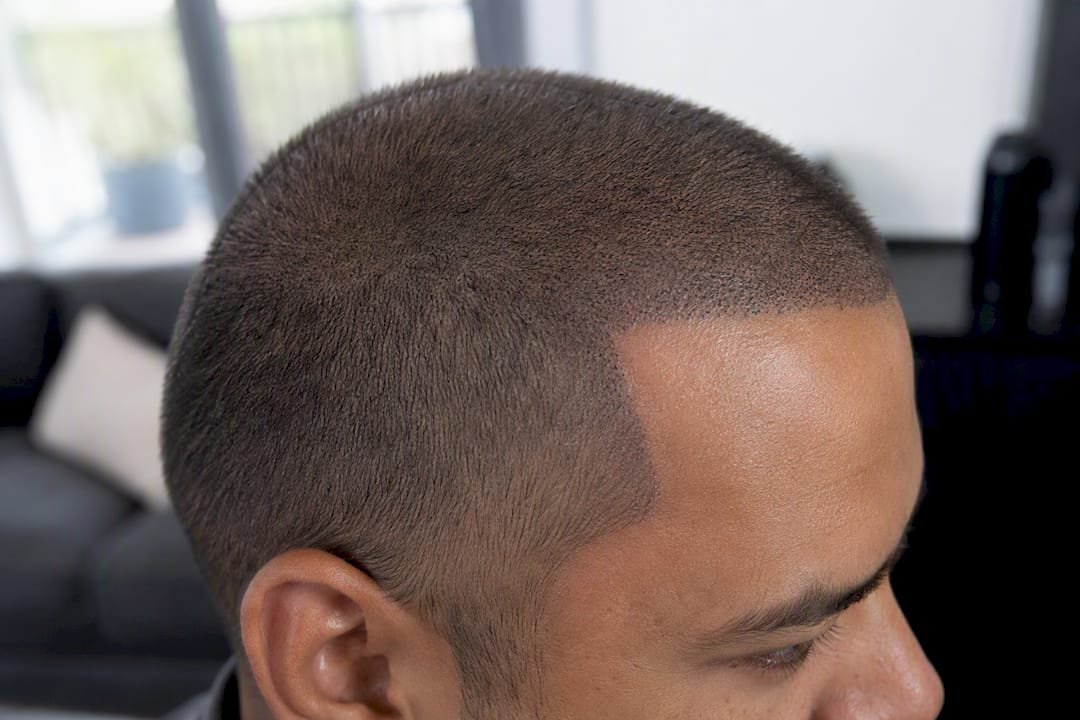 Close-up of scalp with SMP density fill