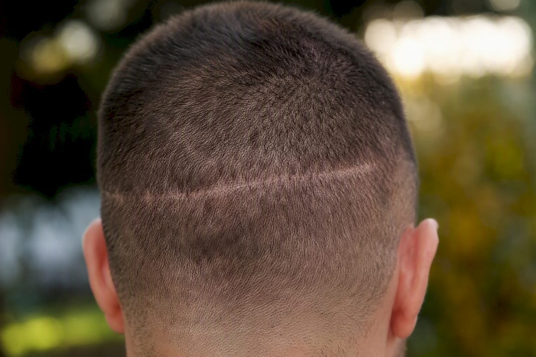 FUT linear scar on buzzed scalp close-up