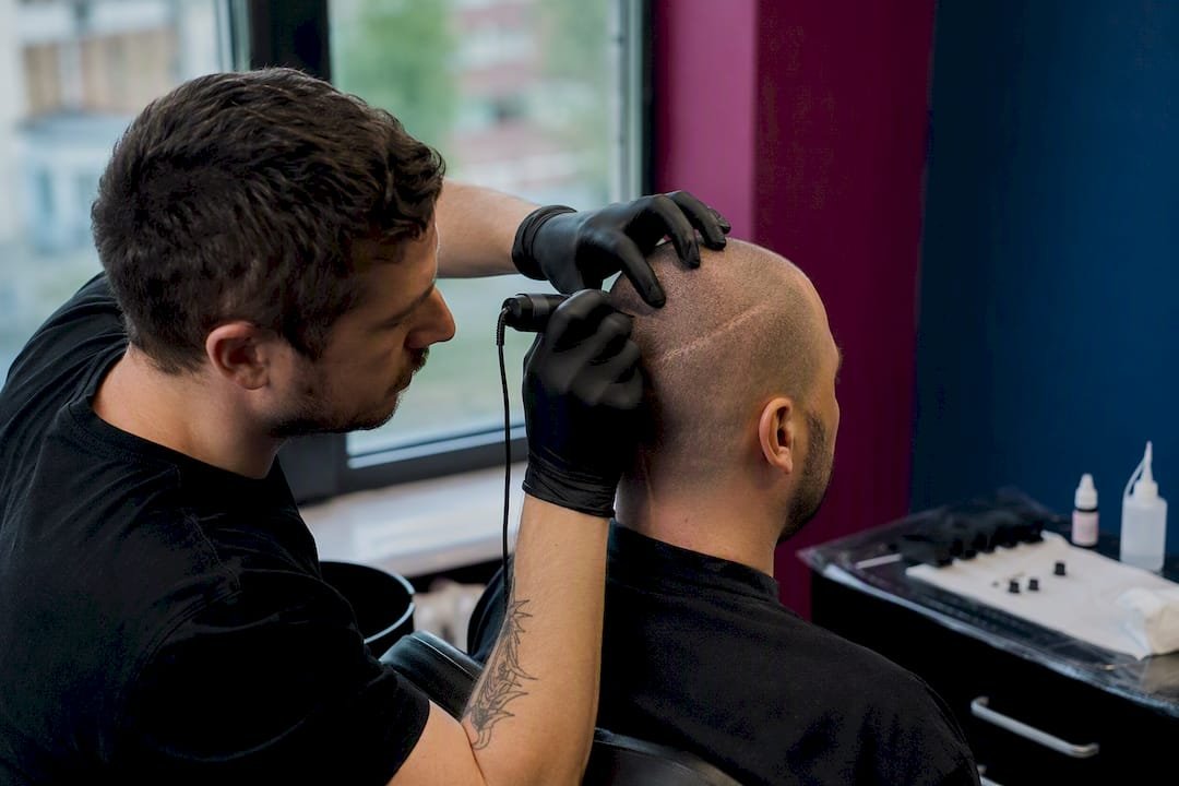 Technician applying scalp micropigmentation on hair transplant scar