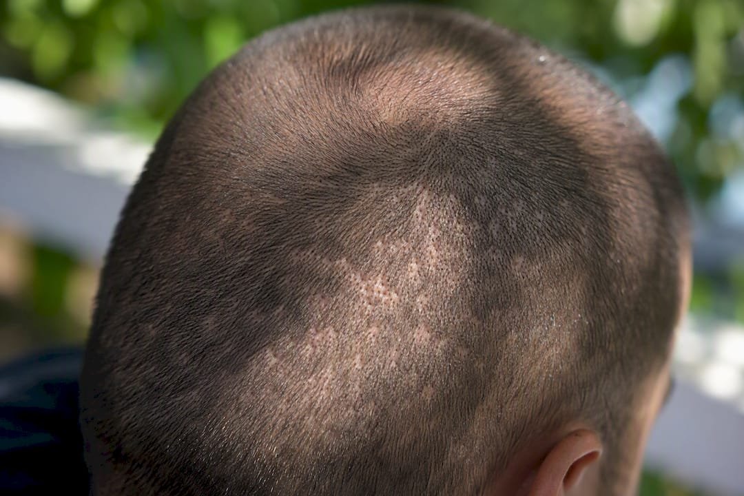 FUE dot scars on buzzed scalp close-up side angle