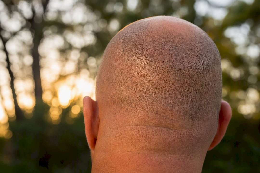 Close-up of faded SMP on balding scalp