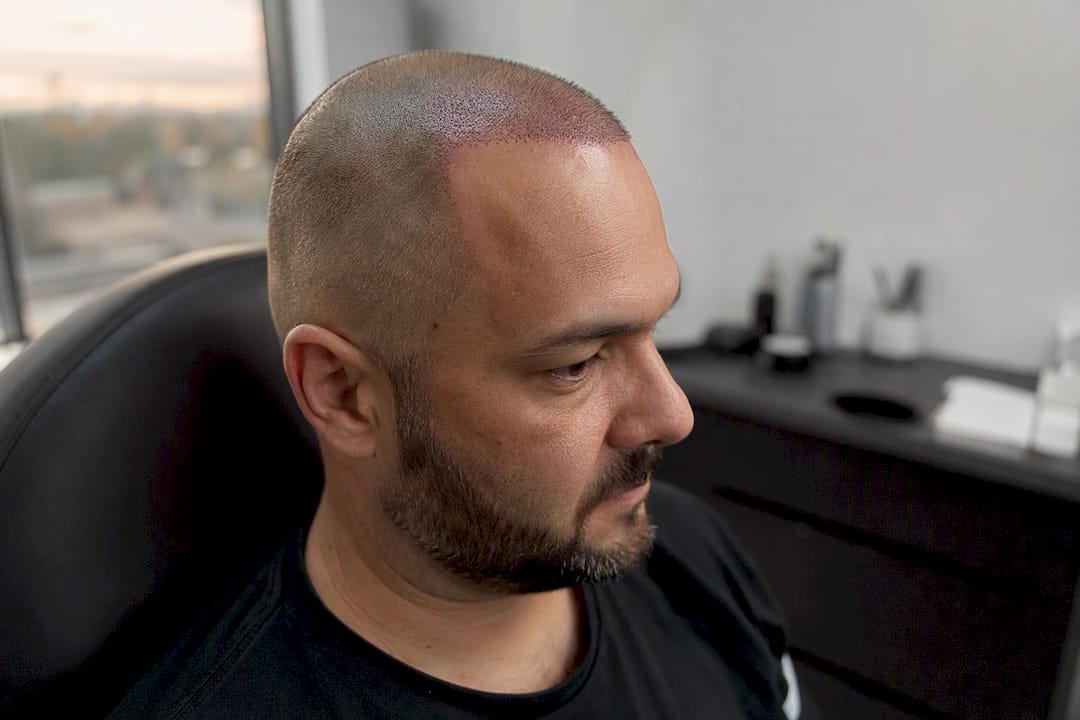 Close-up of healing scalp with SMP dots