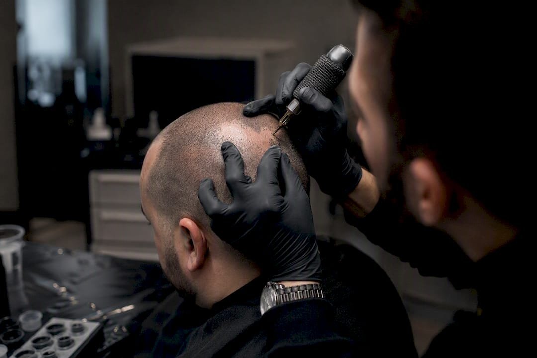 Technician applying scalp micropigmentation on alopecia patch