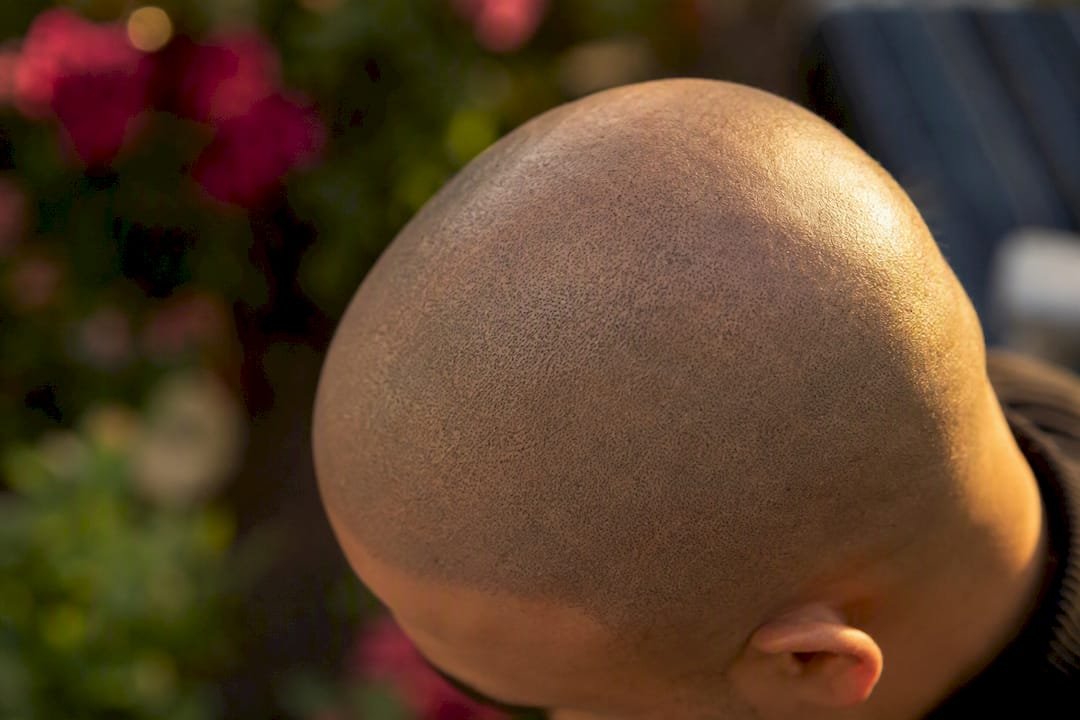 Healed scalp micropigmentation with natural fade