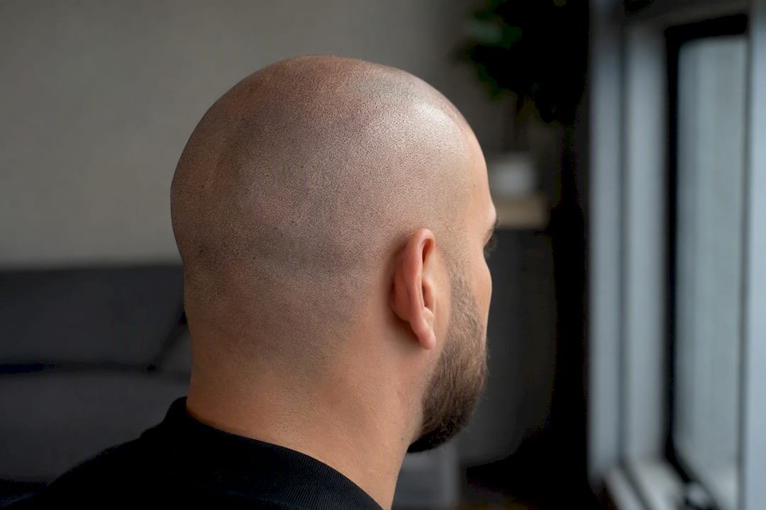 SMP scalp under natural bathroom lighting