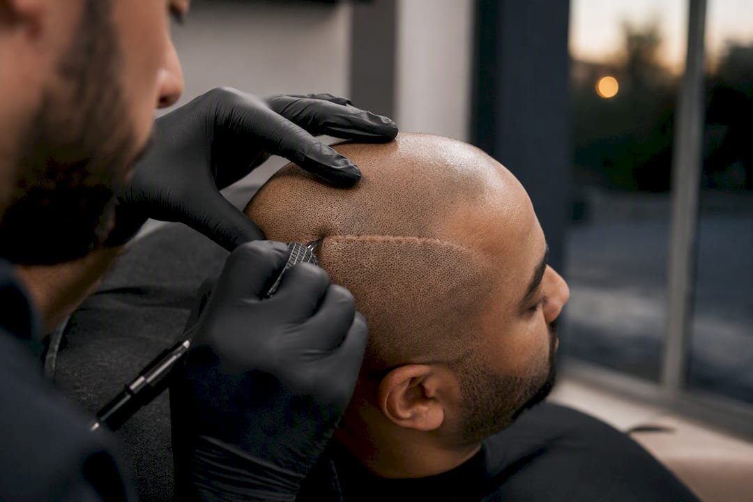 SMP camouflaging scalp scar