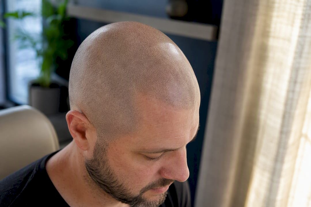Healed scalp micropigmentation on bald scalp