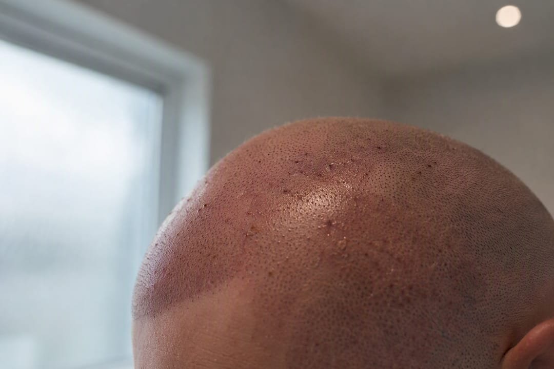 Close-up of healing scalp with slight redness
