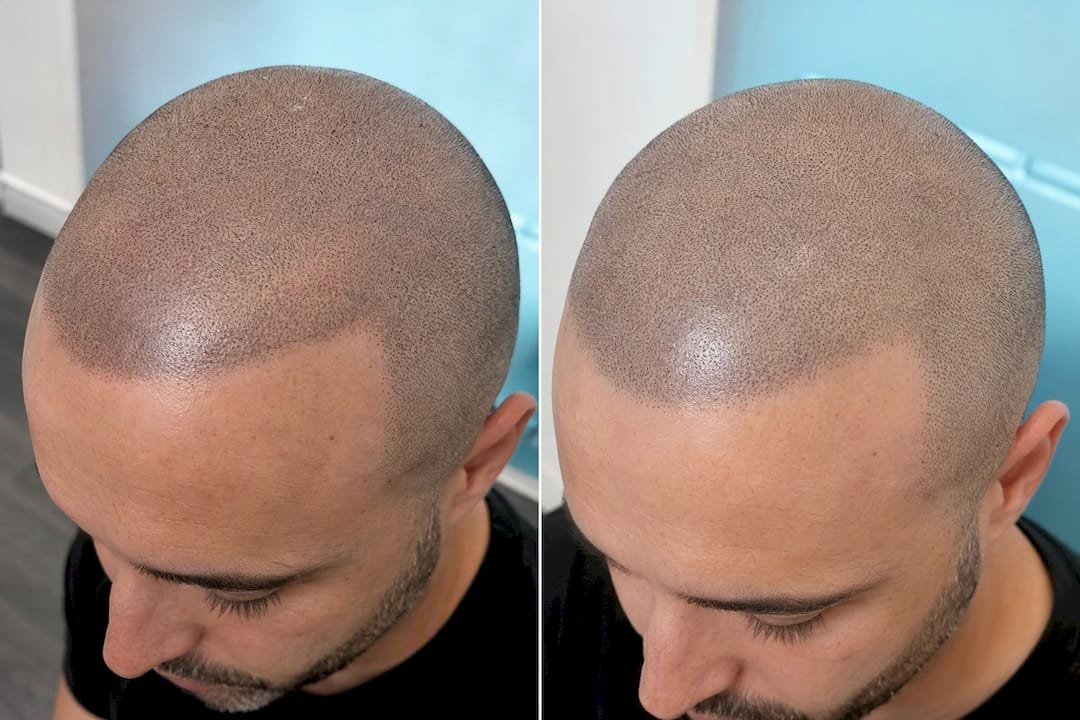 Before and after healed scalp micropigmentation