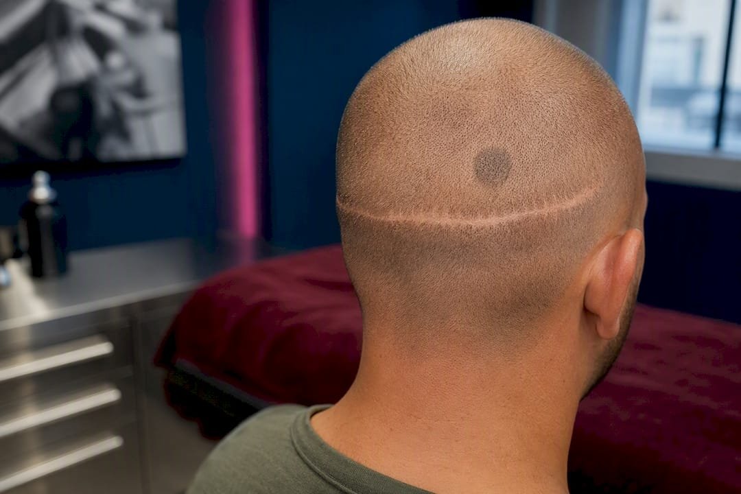 SMP test spot on transplant scar