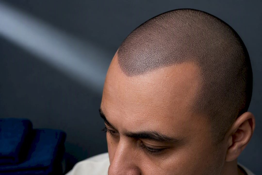 Healed SMP widow's peak on shaved scalp