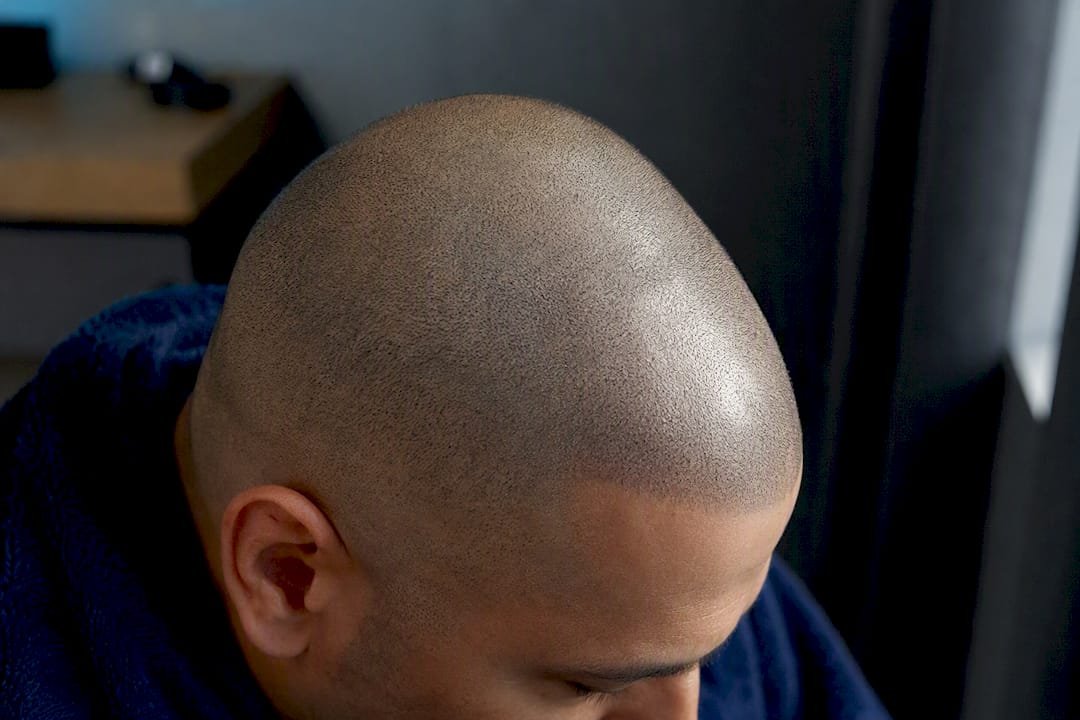 Softened SMP pigment visible across shaved scalp