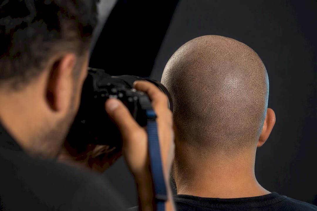 Healed SMP scalp photographed for review