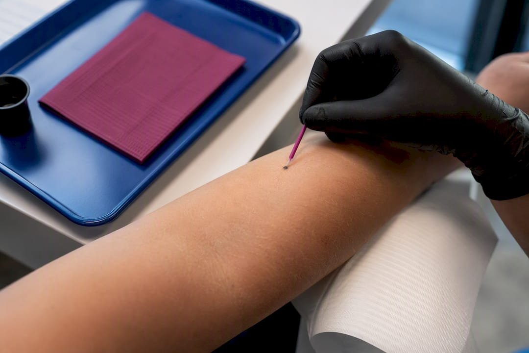 Clinician applying a small pigment patch test