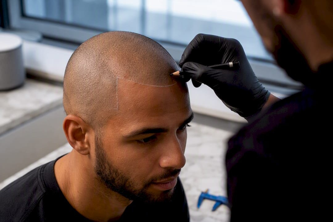 Artist mapping a conservative SMP hairline