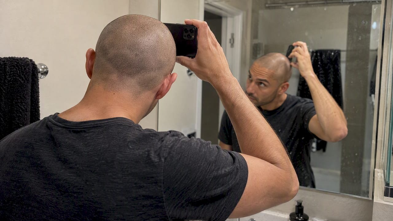 Man photographing healed SMP at home